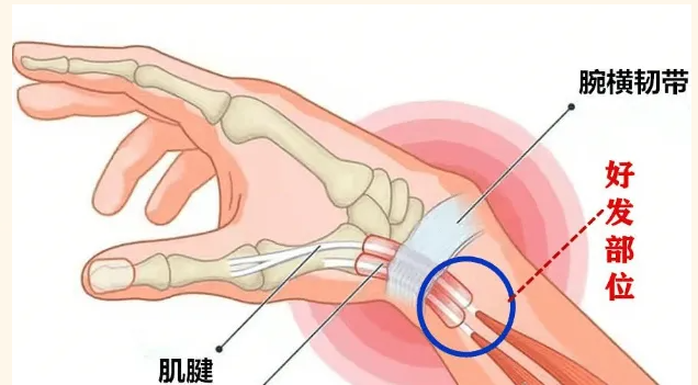 【健康科普】“鼠标手”、“妈妈手”的元凶——腱鞘炎，您了解吗？